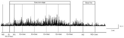 Case Report: Event-Related Desynchronization Observed During Volitional Swallow by Electroencephalography Recordings in ALS Patients With Dysphagia